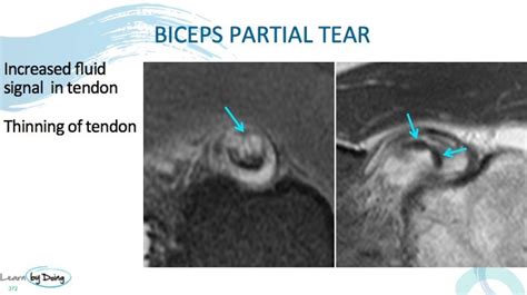 tricep tendon tear test|mri biceps tendon tear protocol.